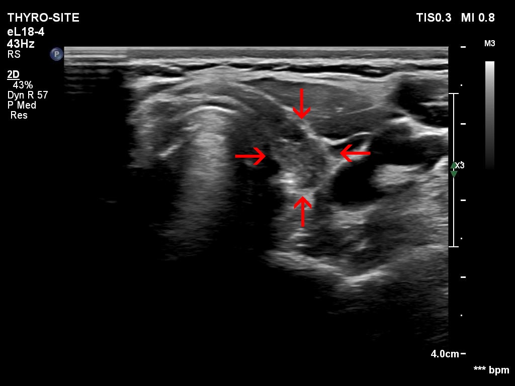 Right lobe, longitudinal scan