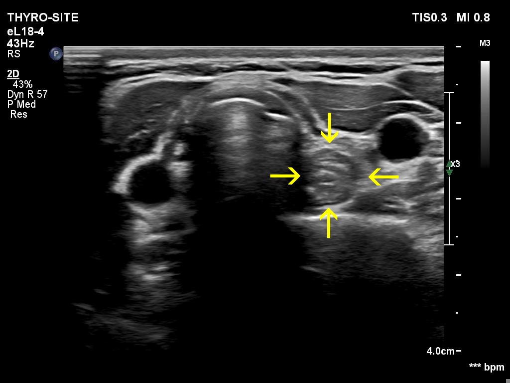 Right lobe, longitudinal scan