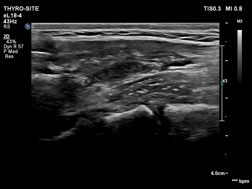 Right lobe, longitudinal scan