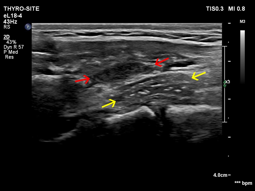 Right lobe, longitudinal scan