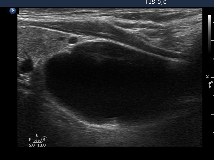 Right lobe, longitudinal scan