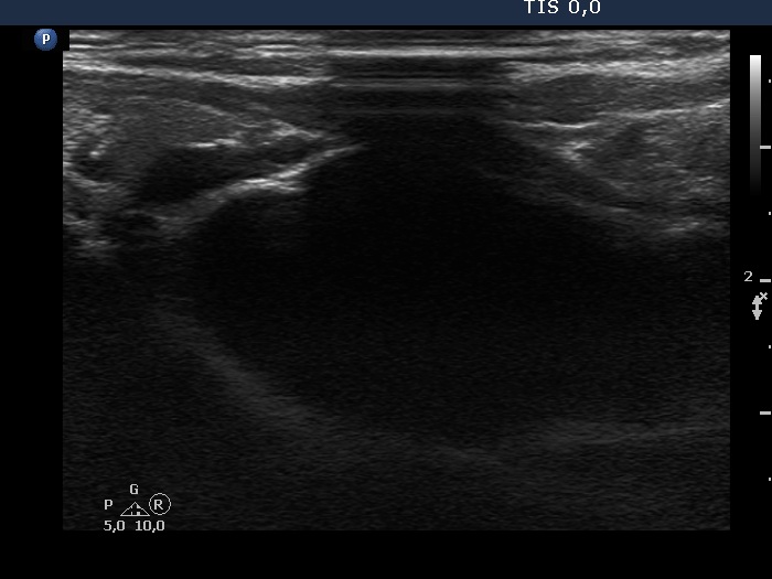 Right lobe, longitudinal scan