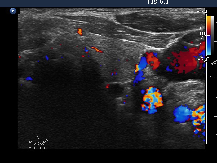 Right lobe, longitudinal scan