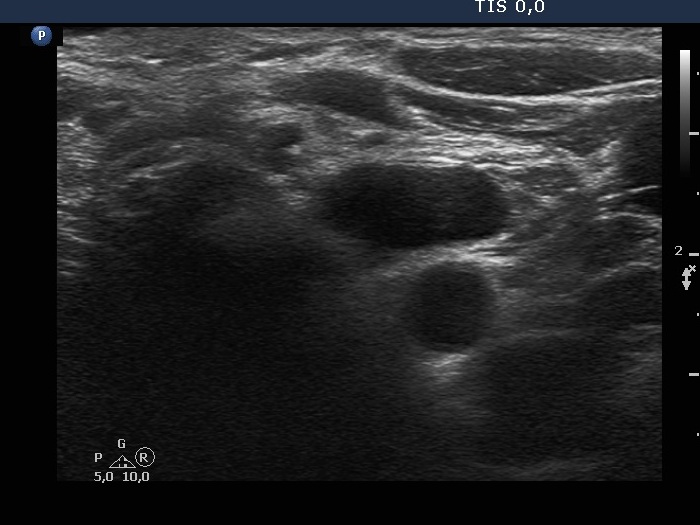 Right lobe, longitudinal scan