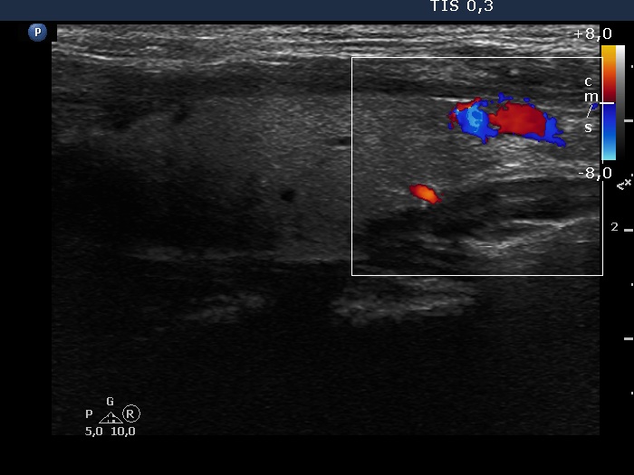 Right lobe, longitudinal scan