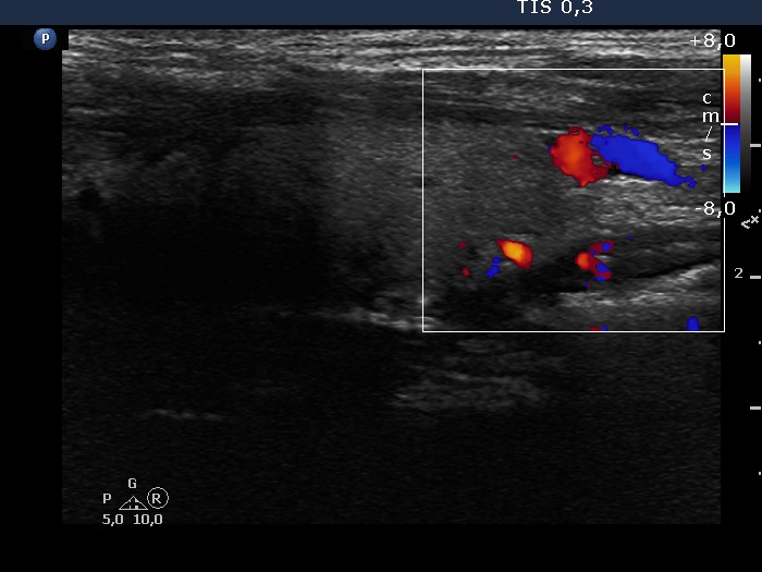 Right lobe, longitudinal scan