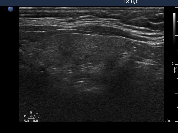Right lobe, longitudinal scan