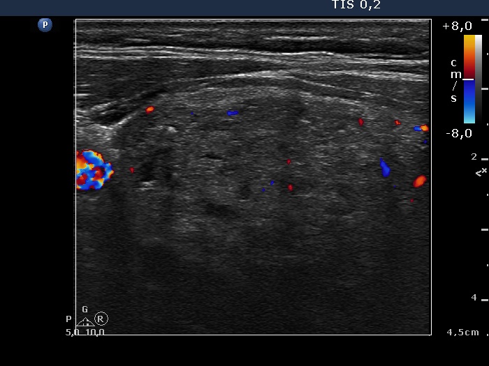 Right lobe, longitudinal scan