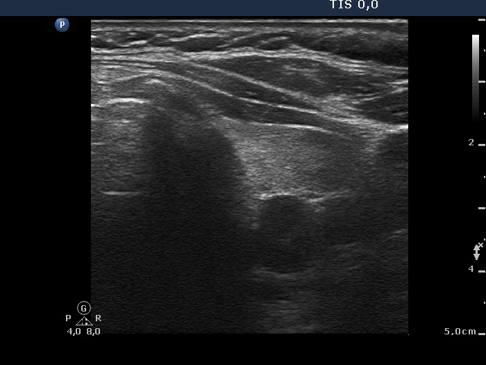 Right lobe, longitudinal scan