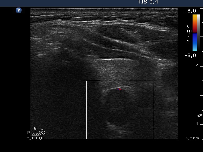 Right lobe, longitudinal scan