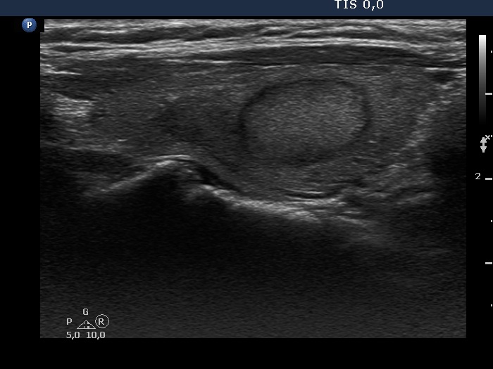 Right lobe, longitudinal scan