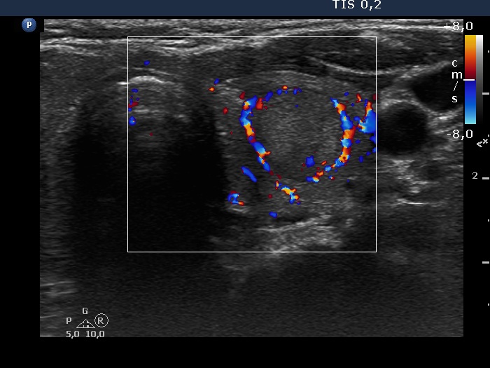 Right lobe, longitudinal scan