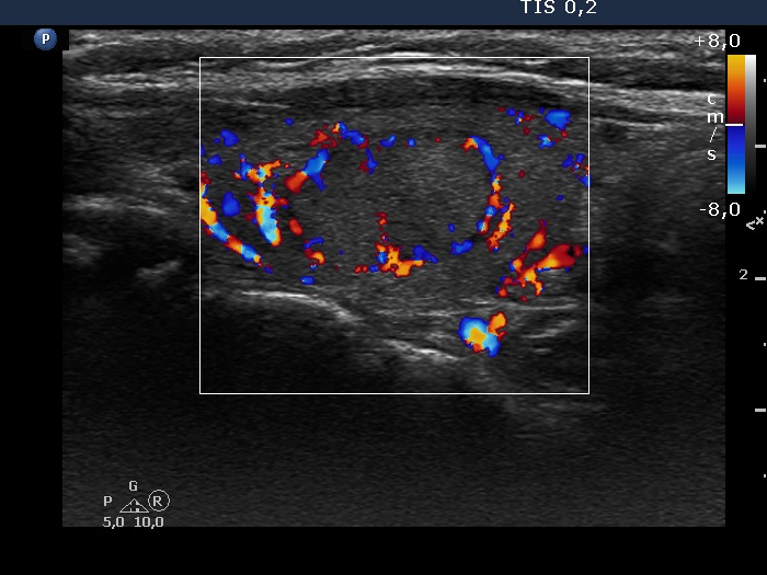 Right lobe, longitudinal scan