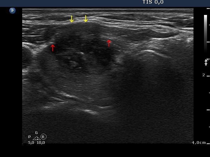 Right lobe, longitudinal scan