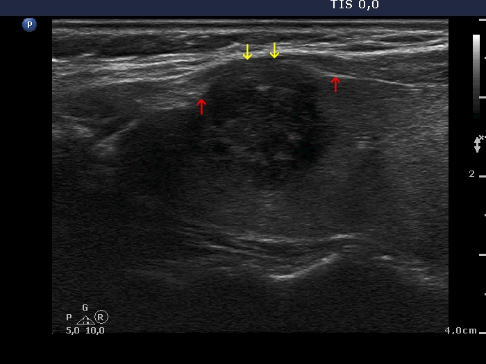 Right lobe, longitudinal scan