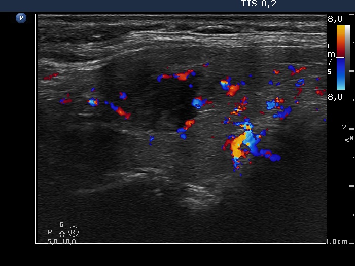 Right lobe, longitudinal scan