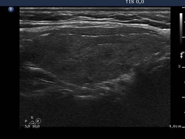Right lobe, longitudinal scan