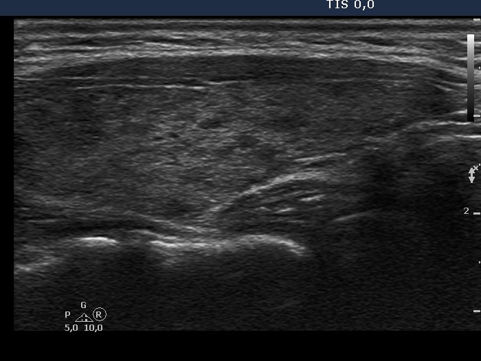 Right lobe, longitudinal scan