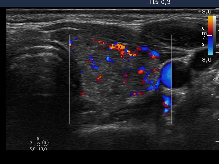 Right lobe, longitudinal scan