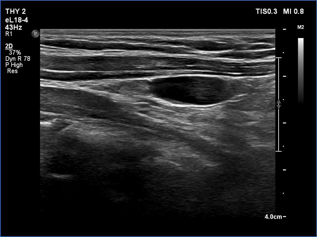 Right lobe, longitudinal scan