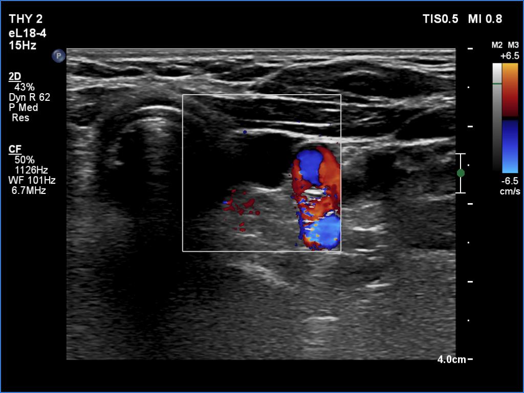 Right lobe, longitudinal scan