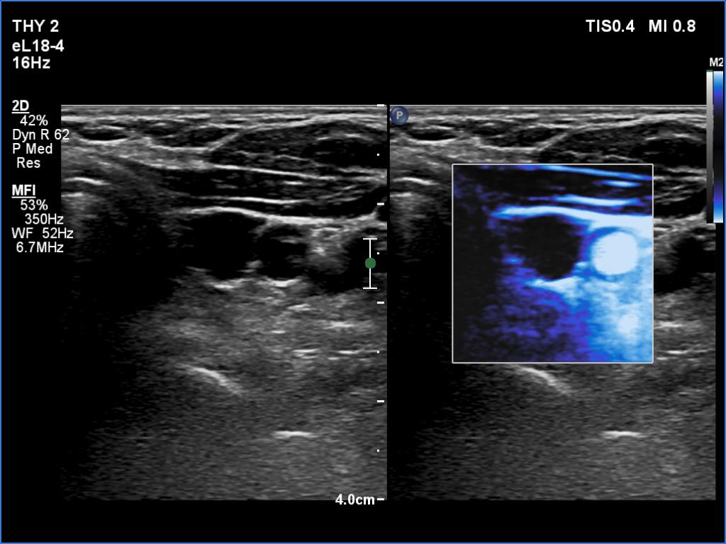 Right lobe, longitudinal scan