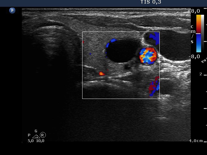 Right lobe, longitudinal scan