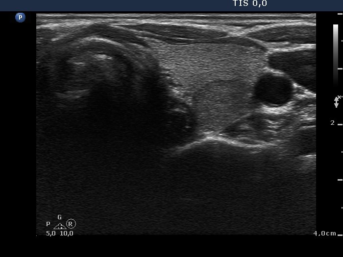 Right lobe, longitudinal scan