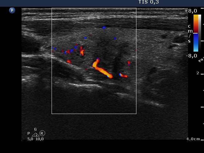 Right lobe, longitudinal scan