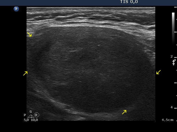 Right lobe, longitudinal scan