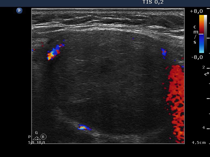 Right lobe, longitudinal scan