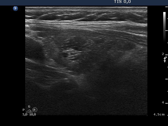 Right lobe, longitudinal scan