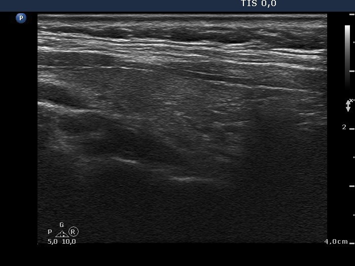 Right lobe, longitudinal scan