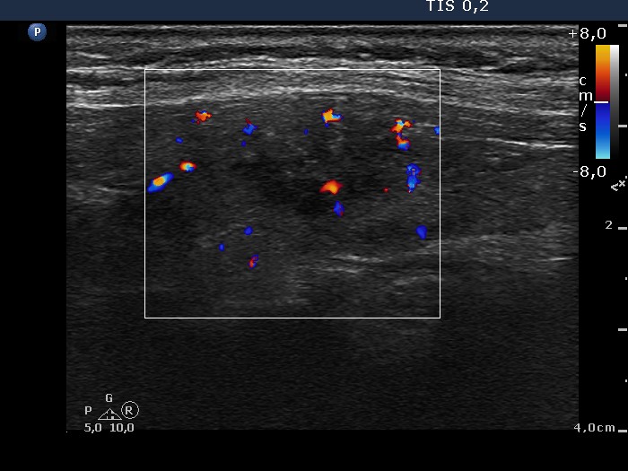 Right lobe, longitudinal scan