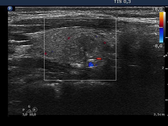 Right lobe, longitudinal scan