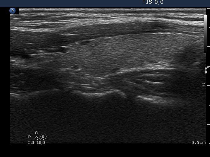 Right lobe, longitudinal scan
