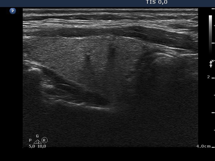 Right lobe, longitudinal scan