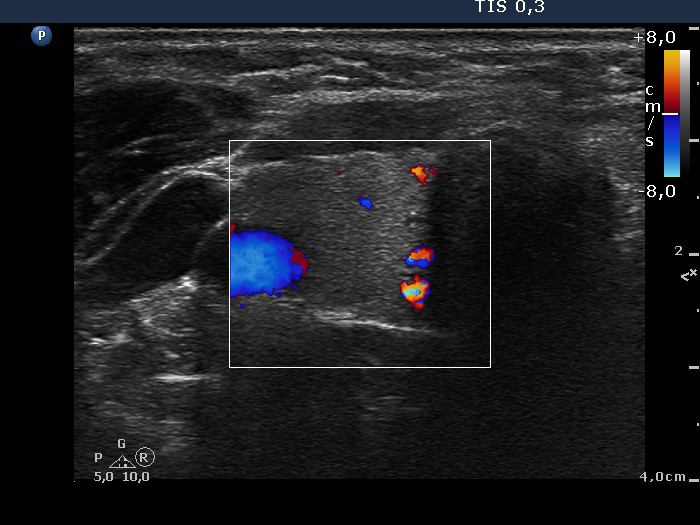 Right lobe, longitudinal scan