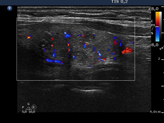 Right lobe, longitudinal scan