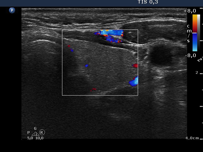Right lobe, longitudinal scan