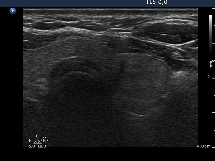 Right lobe, longitudinal scan