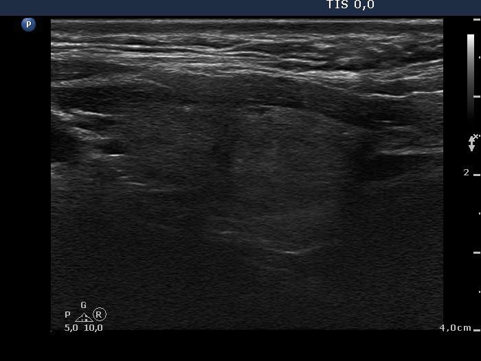Right lobe, longitudinal scan