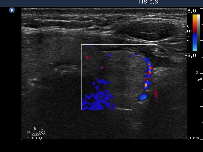 Right lobe, longitudinal scan