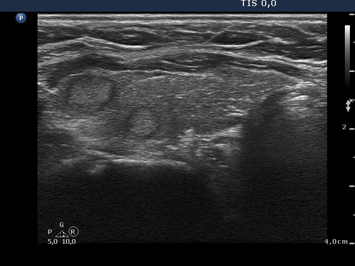 Right lobe, longitudinal scan