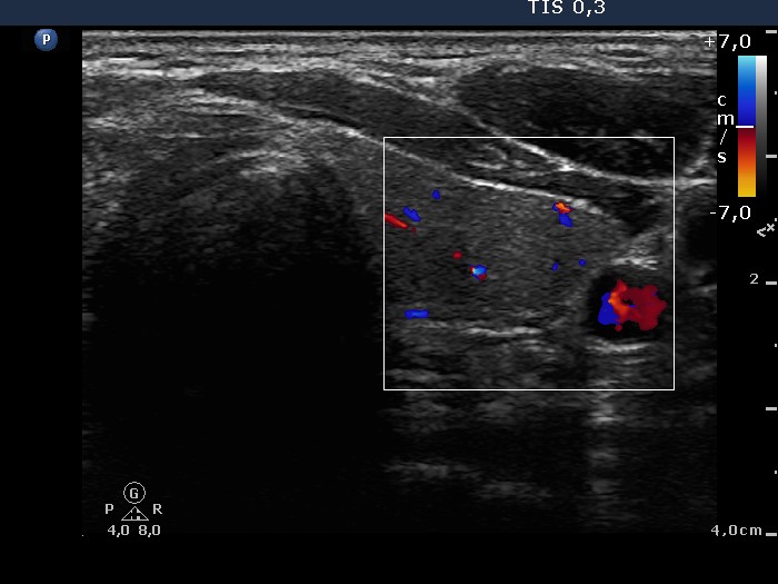 Right lobe, longitudinal scan
