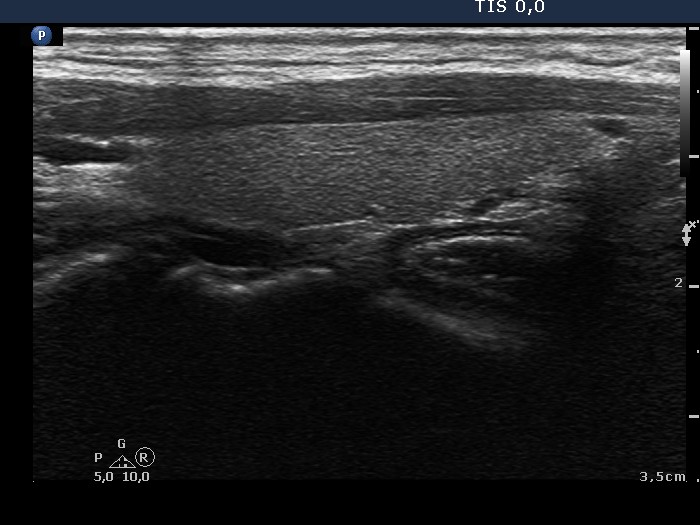 Right lobe, longitudinal scan