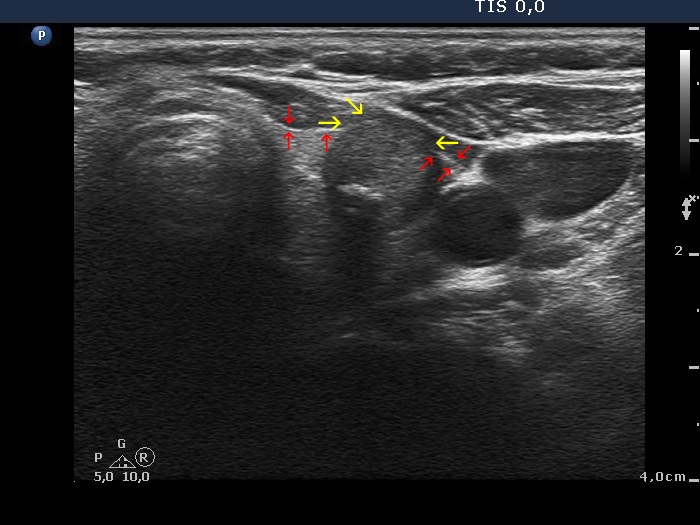 Right lobe, longitudinal scan
