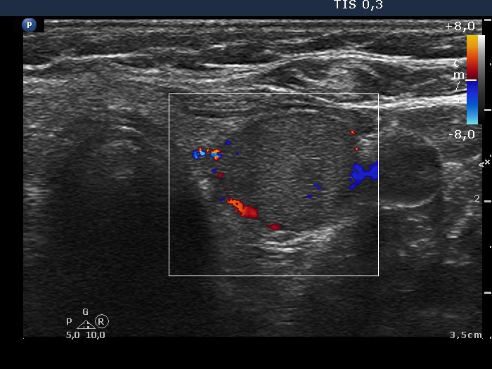 Right lobe, longitudinal scan