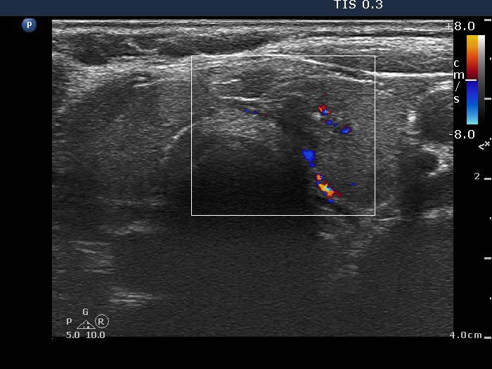 Right lobe, longitudinal scan