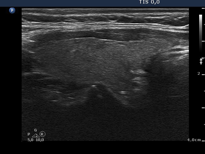 Right lobe, longitudinal scan